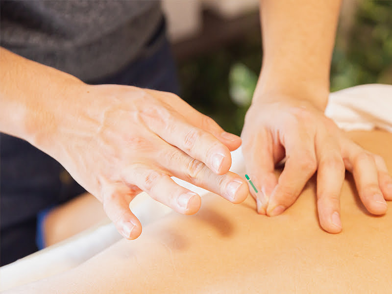Acupunctuur
